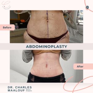 Abdominoplasty