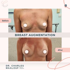 Breast Augmentation