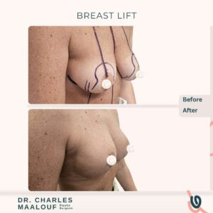 Breast Lift