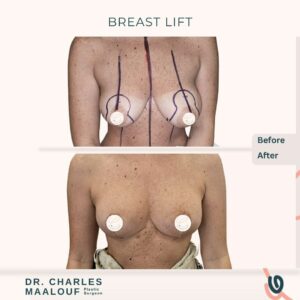 Breast Lift