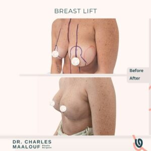 Breast Lift