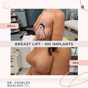 Breast Lift