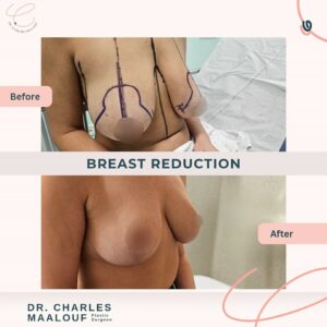 Breast Reduction