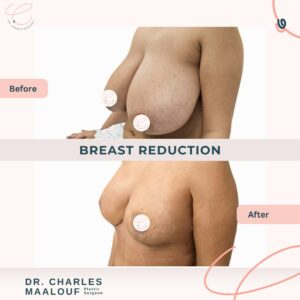 Breast Reduction