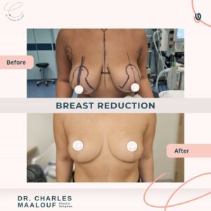 Breast Reduction