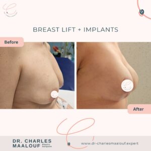 Breast Lift