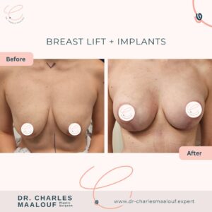 Breast Lift