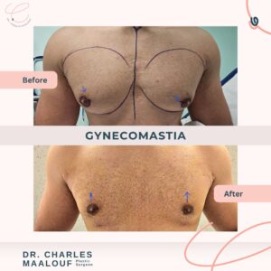 gynecomastia