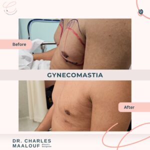 gynecomastia