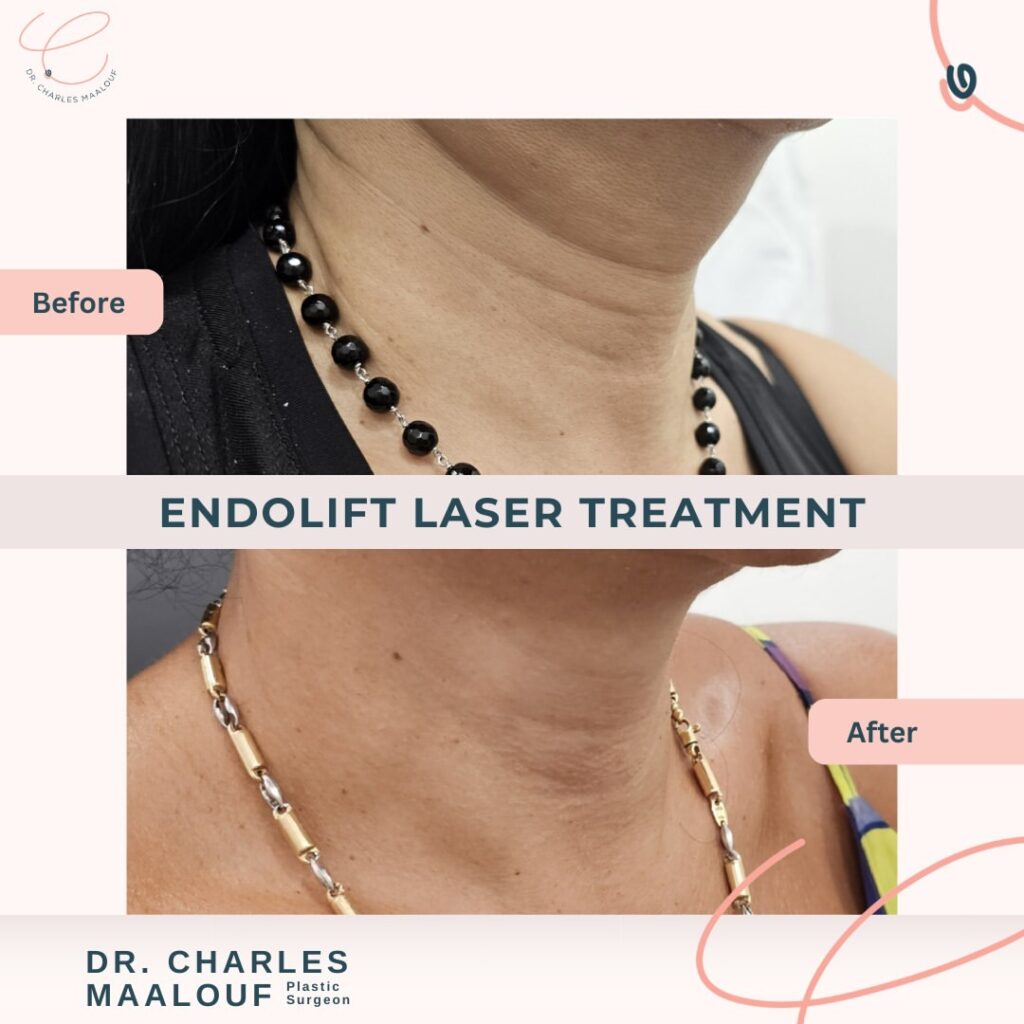 Endolift Laser Treatment