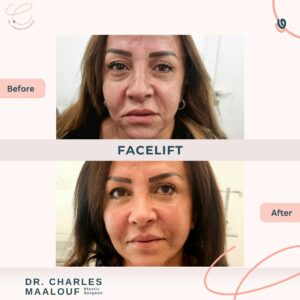 Face lift