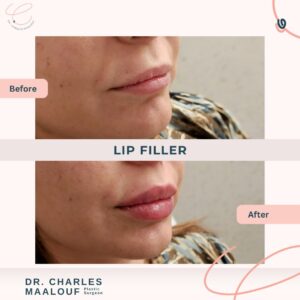 Lip Filler