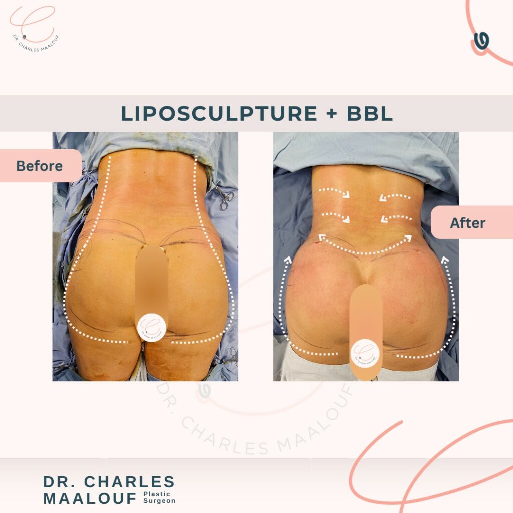 Liposcupture + bbl Lebanon