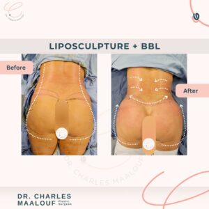 Liposcupture + bbl