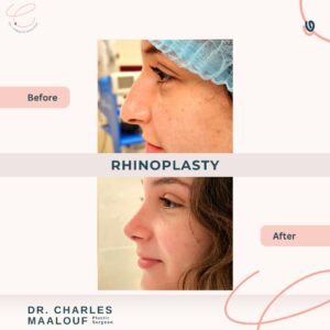 Rhinoplasty