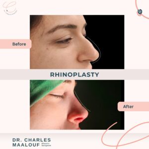 Rhinoplasty