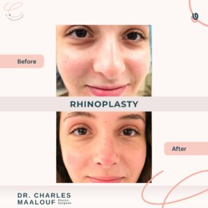 Rhinoplasty