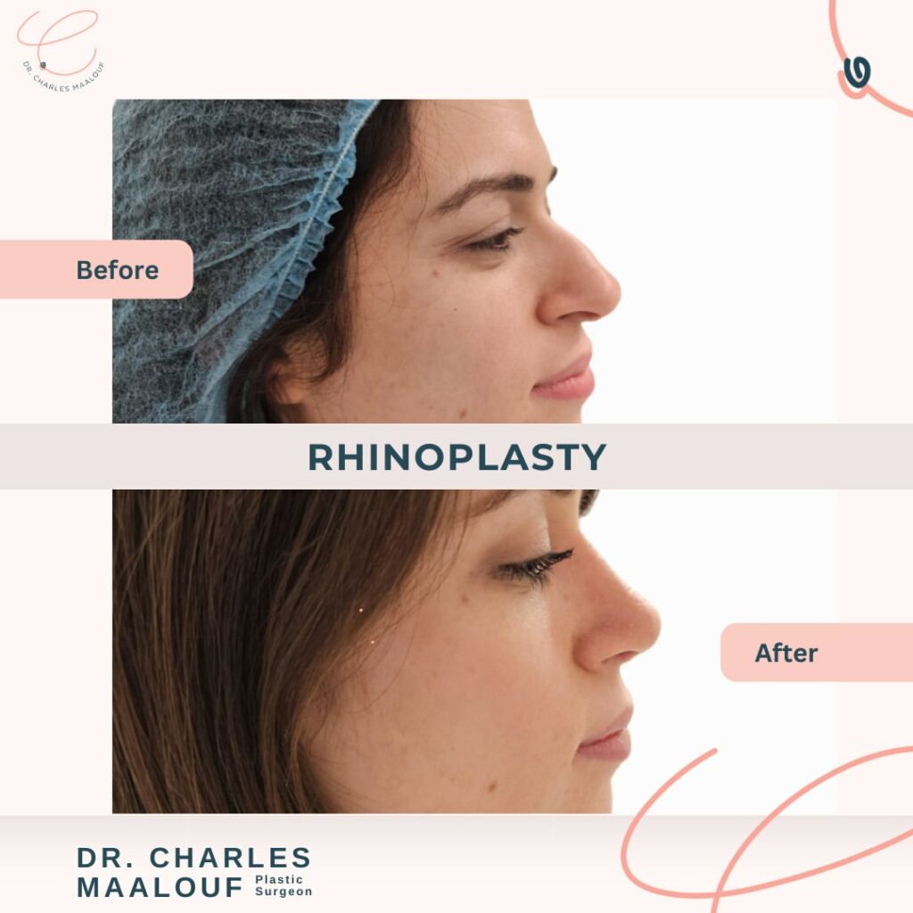 Rhinoplasty