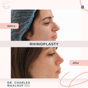 Rhinoplasty