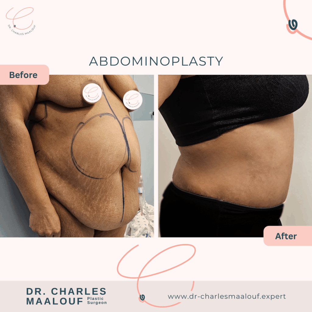 abdominoplasty, liposuction lebanon