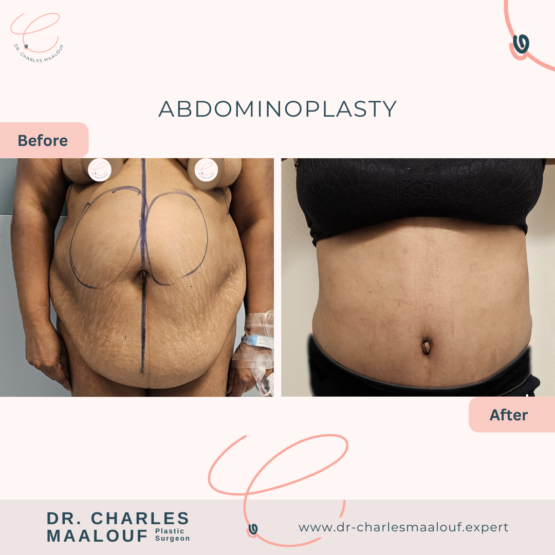 abdominoplasty, liposuction lebanon