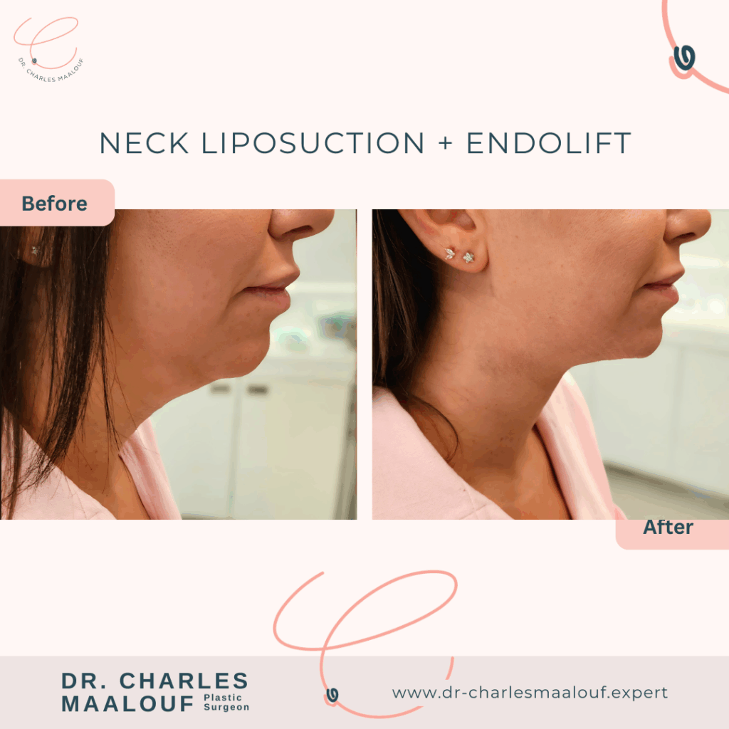 neck liposuction lebanon